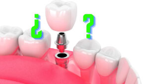 Implante dental Coslada